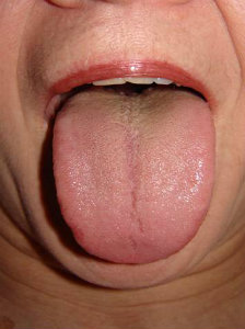 Acupuncture of Iowa Iowa City Q&A Assessments tongue